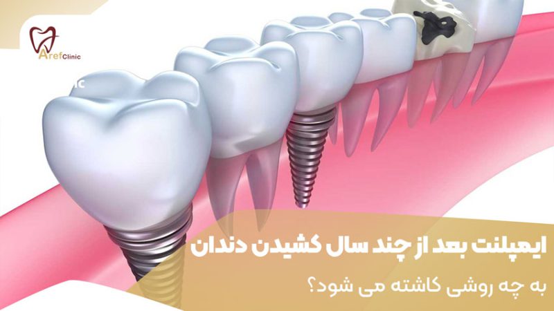 ایمپلنت بعد از چند سال کشیدن دندان به چه روشی کاشته می شود؟