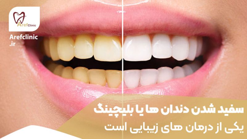 سفید شدن دندان ها یا بلیچینگ یکی از درمان های زیبایی است