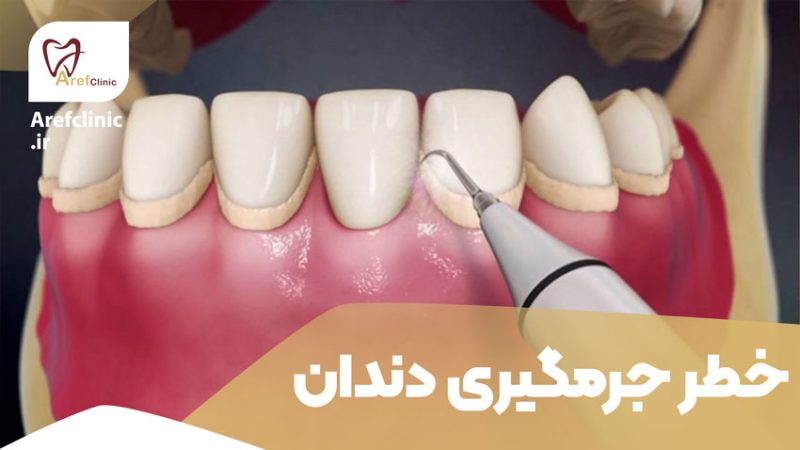 خطر جرمگیری دندان