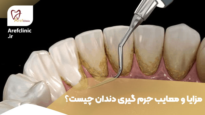مزایا و معایب جرم گیری دندان چیست