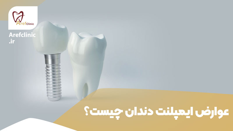 عوارض ایمپلنت دندان چیست
