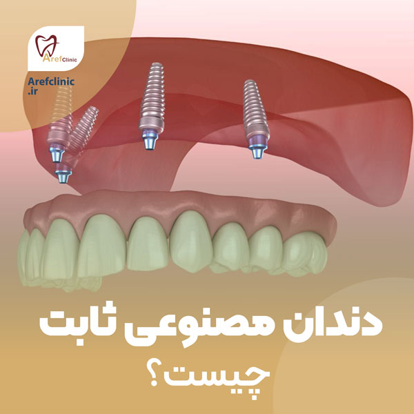 دندان مصنوعی ثابت چیست