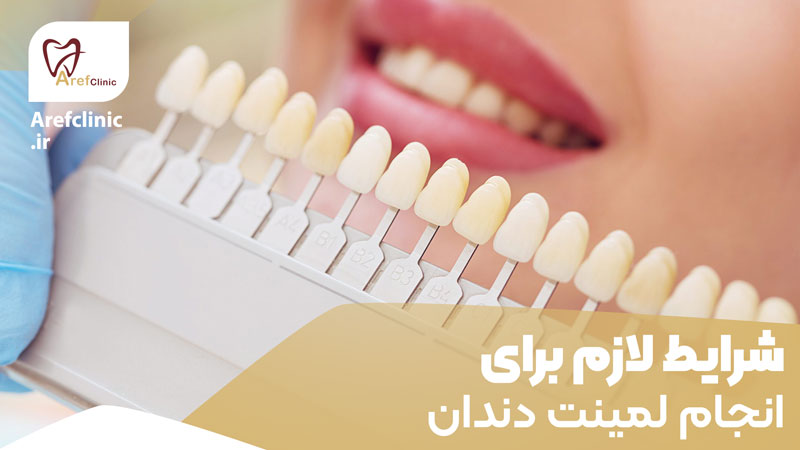 شرایط لازم برای انجام لمینت دندان