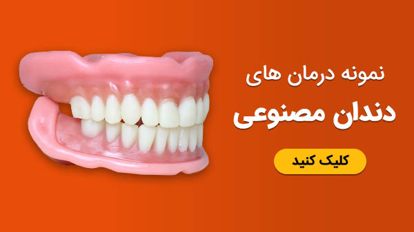 نمونه درمان های دندان مصنوعی