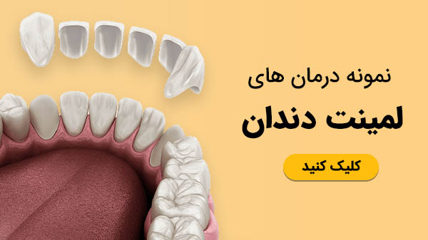 نمونه درمان لمینت دندان