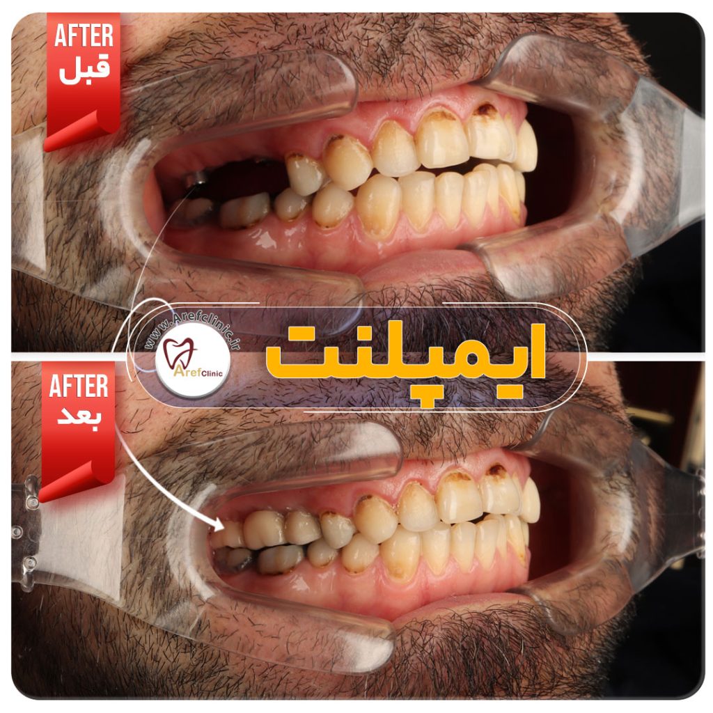 نمونه کار های ایمپلنت دندان در کرج