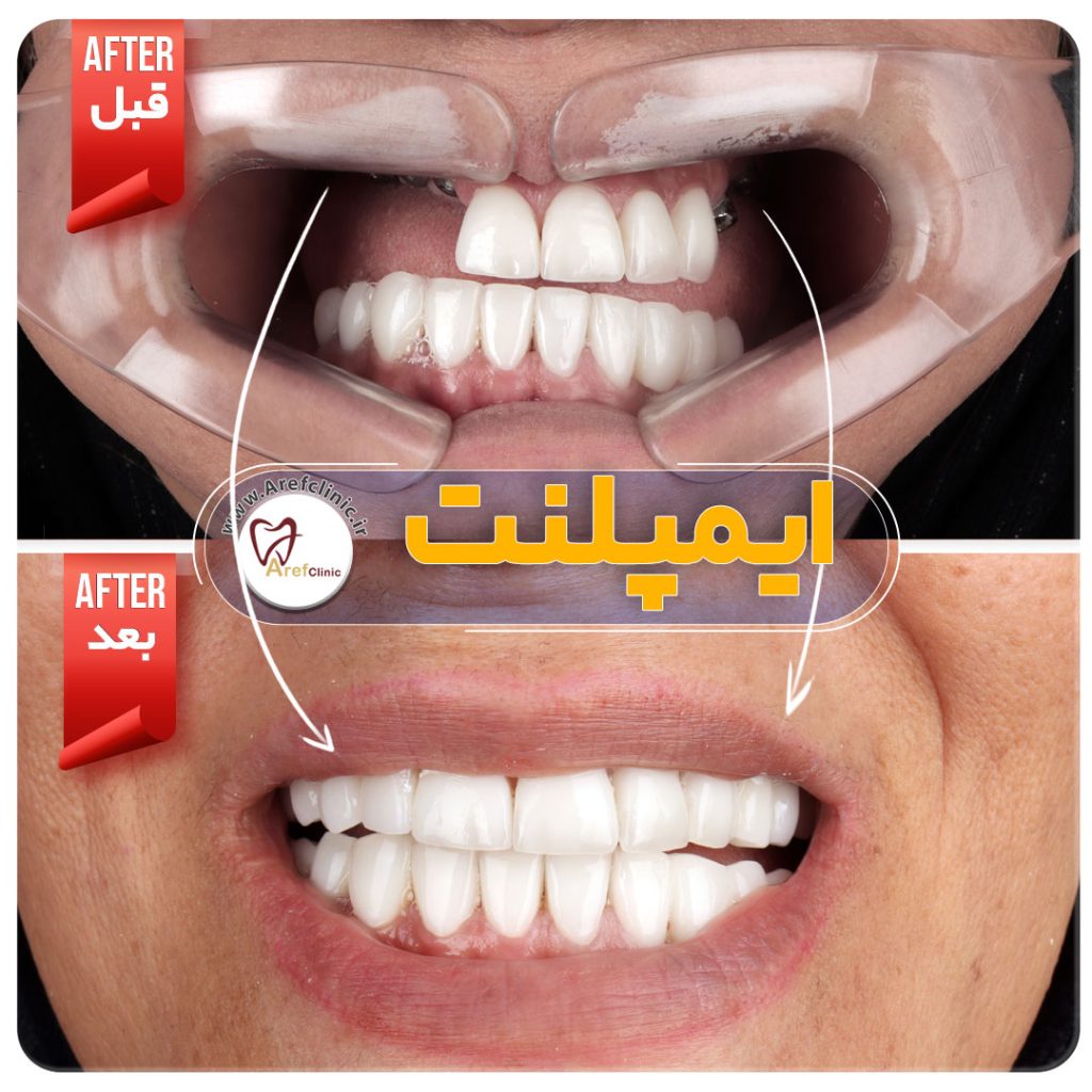 نمونه کار های ایمپلنت دندان در کرج