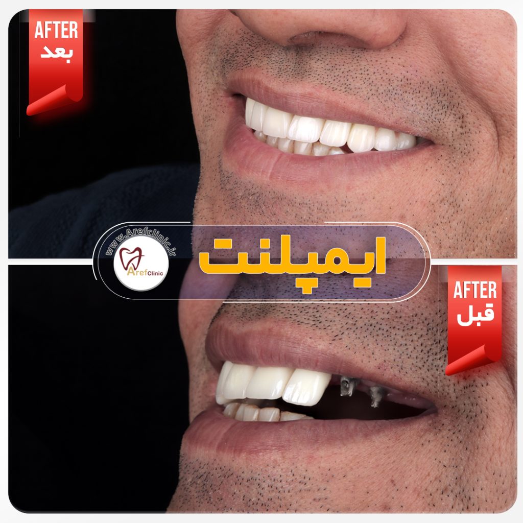 نمونه کار های ایمپلنت دندان در کرج