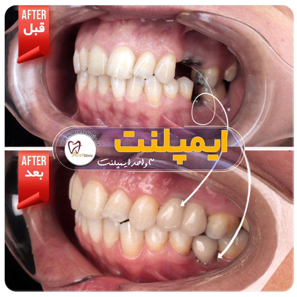 نمونه کار های ایمپلنت دندان در کرج