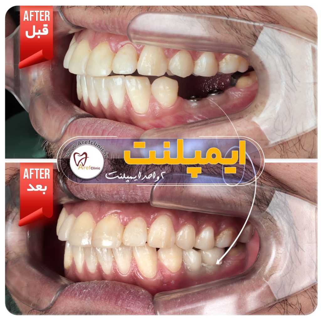 نمونه کار های ایمپلنت دندان در کرج