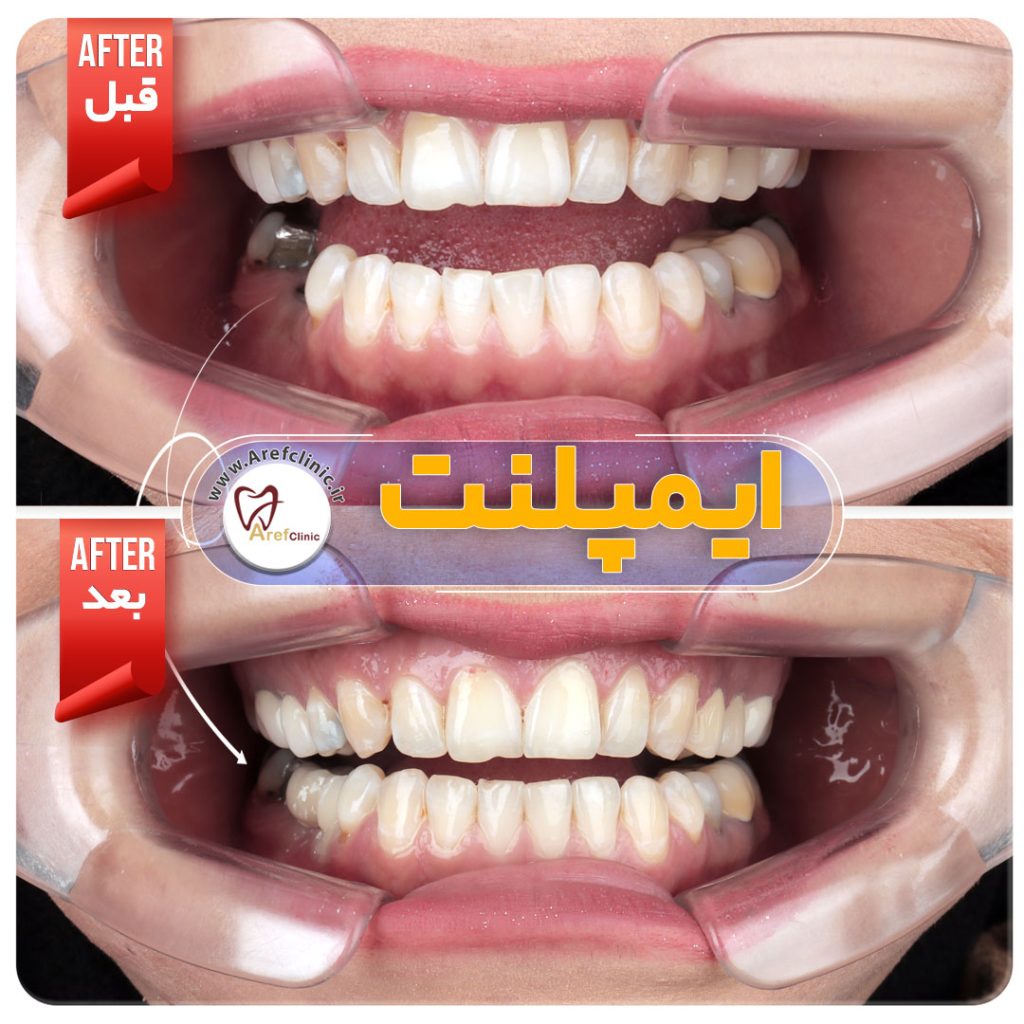 نمونه کار های ایمپلنت دندان در کرج