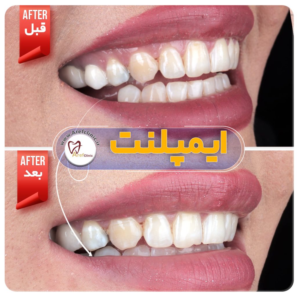 نمونه کار های ایمپلنت دندان در کرج