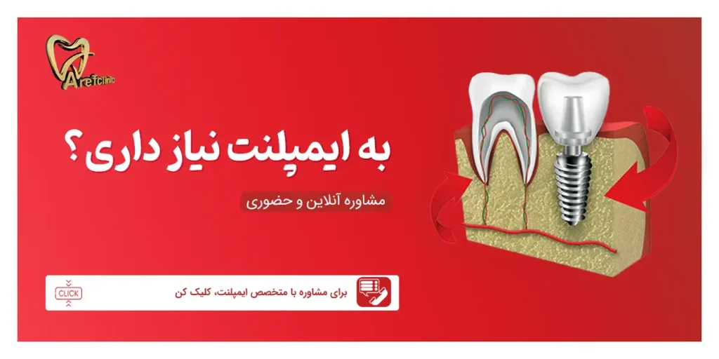 درخواست مشاوره برای ایمپلنت دندان در کرج