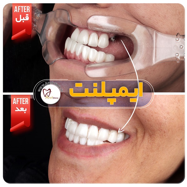 ایمپلنت دندان در کلینیک دندان پزشکی کرج دکتر عارف