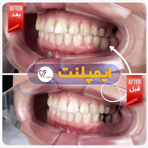 نمونه کار درمان ایمپلنت دندان در فردیس