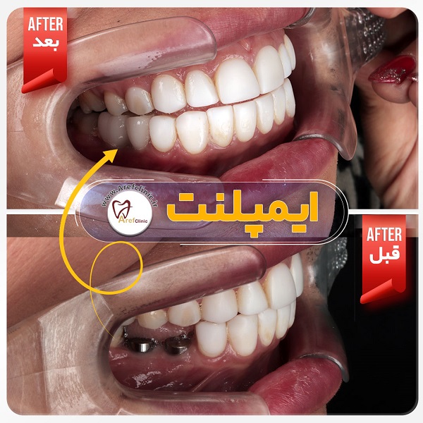 ایمپلنت دندان در فردیس کرج