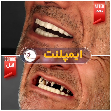 ایمپلنت دندان در کرج