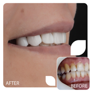 کامپوزیت (5)