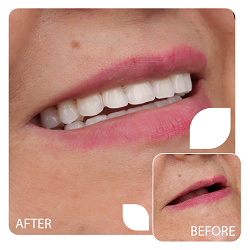 بهترین دندان مصنوعی برای بانوان در کرج