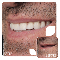 نمونه کار دندان مصنوعی در فردیس