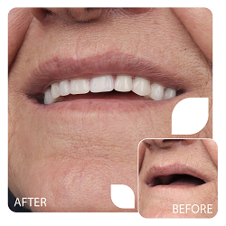 نمونه کار دندان مصنوعی در کرج