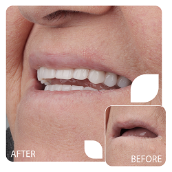 نمونه کار دندان مصنوعی در کرج