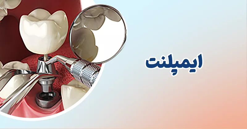 ایمپلنت دندان در کرج